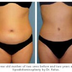 Dr. Kalus: 33 year old mother of two: Before/After lipoabdominoplasty