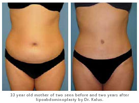 Dr. Kalus: 33 year old mother of two: Before/After lipoabdominoplasty