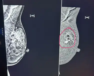 Photgraph of medical imaging: These breast images show the difference between a typical mammogram (left) and a contrast-enhanced mammogram.